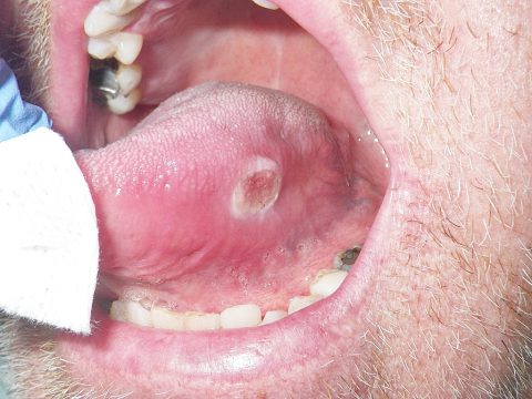 Câncer bucal avança de forma silenciosa e especialistas alertam para sinais ignorados