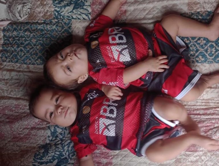 Gêmeas siamesas que nasceram em Manaus comemoram 1 ano após cirurgia complexa