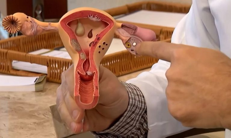 Mioma pode evoluir para um câncer? Especialista explica