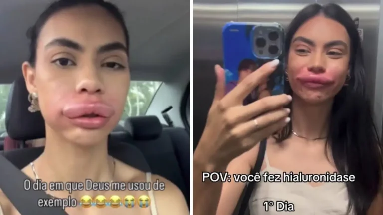 Modelo fica irreconhecível ao remover preenchimento labial