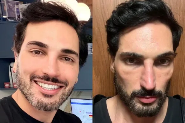 Antes e depois de influenciador viraliza após uso de caneta emagrecedora